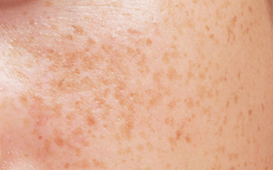 How to Say “Freckles” in Spanish? What is the meaning of “Pecas”?